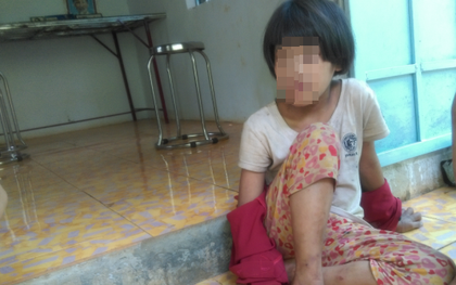 Tương lai mờ mịt của bé gái từng bị mẹ cắt gân chân