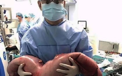 Mổ bụng bệnh nhân, bác sĩ tá hỏa khi phát hiện khối đại tràng dài 76cm do bị táo bón nhiều năm