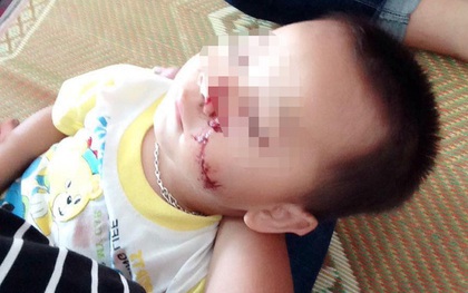 Sự thật câu chuyện bố chém con trai 2 tuổi rách mặt ở Tuyên Quang