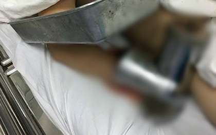 Một phụ nữ nhập viện với máy xay thịt dính vào tay