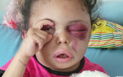 Hình ảnh cô bé 5 tuổi khiến cả thế giới phải sững sờ  trước thảm hoạ nhân đạo tại quê hương Yemen