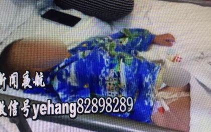 Bé trai 2 tuổi bị bỏng bộ phận sinh dục vì tè dầm khi ngủ trên thảm điện