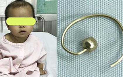 Phụ huynh cẩn trọng: Giật hoa tai của mẹ nuốt vào bụng, bé gái 7 tháng tuổi bị rách thực quản