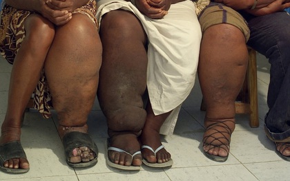 Chuyện của những đôi chân khổng lồ: Cuộc sống như địa ngục của hàng triệu người mắc bệnh chân voi
