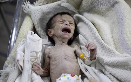 Hình ảnh em bé Syria suy dinh dưỡng, gầy trơ xương khiến cả thế giới rúng động