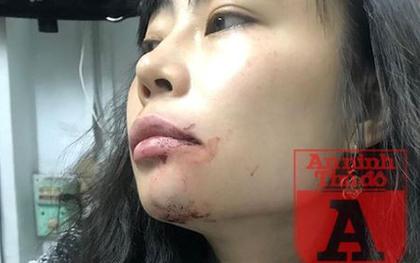 Nữ hành khách bị lái xe Uber đánh "bầm mặt": Tôi cần một lời xin lỗi công khai!