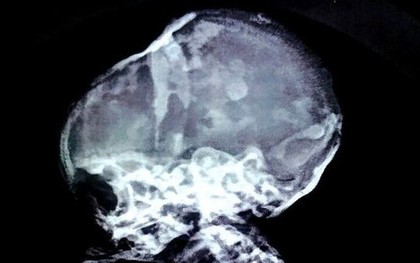 Tá hỏa phát hiện em bé "hóa đá" ở trong bụng mẹ suốt 15 năm