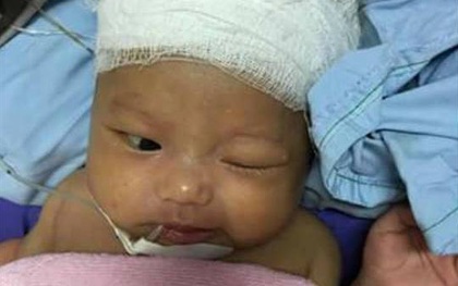Quảng Ninh: Phẫu thuật ghép sọ não thành công cho bé trai 37 ngày tuổi