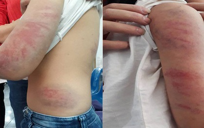 Bố say rượu liên tục đánh, đạp vào bụng con gái 9 tuổi ở Vĩnh Phúc