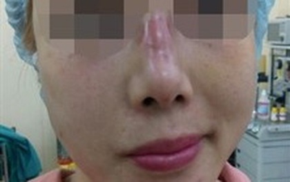Bị thối thịt sau 2 ngày cấy chỉ nâng mũi