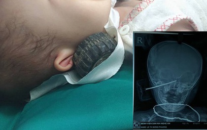 Kinh hãi hình ảnh bánh xe đồ chơi nhọn cắm sâu vào đầu bé gái 11 tháng tuổi