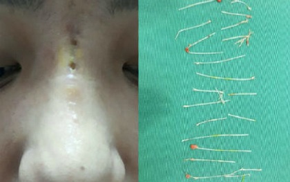 Mũi nữ diễn viên thủng nhiều lỗ sau 2 tháng cấy chỉ nâng mũi