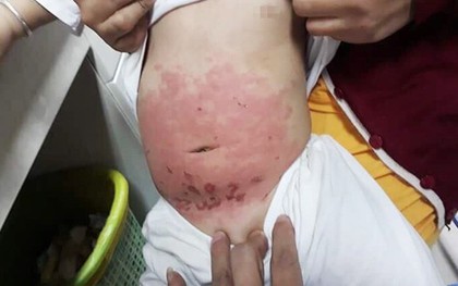 Mẹ bôi dầu khuynh diệp trực tiếp lên người con quá nhiều, bé gái 14 tháng tuổi bị bỏng da bụng