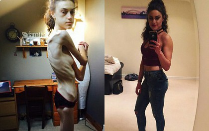Từng bị gọi là "bộ xương di động" và nhiều phen tưởng chết, cô gái trẻ 32 kg thay đổi không ai nhận ra