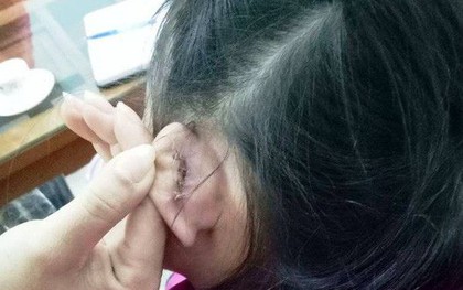 Học sinh bị rách tai khâu 4 mũi, hiệu trưởng nói "nghe phong thanh"