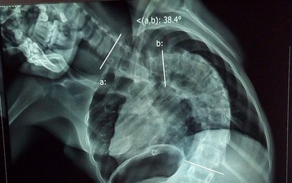TP.HCM: Cột sống ngực vẹo 111 độ, lưng bé gái 12 tuổi cong như hình chữ S