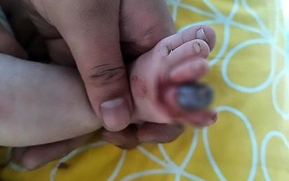 Ngón chân bé trai 2 tháng tuổi bị hoại tử, có nguy cơ phải cắt bỏ chỉ vì 1 sợi tóc vương vãi