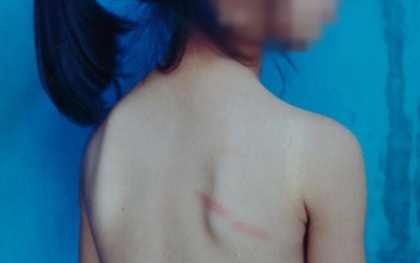 Nghệ An: Học sinh lớp 1 bị cô giáo đánh thâm tím lưng và chân vì không làm được bài