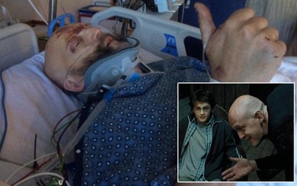 Diễn viên phim "Harry Potter" bị gãy cổ, thủng phổi sau tai nạn ô tô kinh hoàng