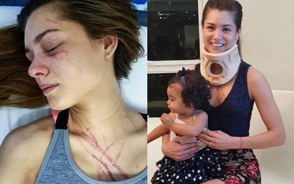 Hoa hậu Venezuela bị nữ ca sĩ đánh trầy mặt, chấn thương khắp người đến mức nhập viện