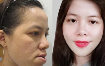 27 năm không khép được miệng và bị gọi là “đồ mặt méo”, cô gái tiến hành ca đại phẫu đổi diện mạo và kết quả không ngờ