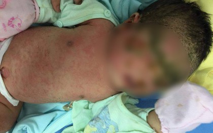 Bé 1 tháng tuổi toàn thân bong tróc mảng lớn vì tắm lá, bác sĩ cảnh báo thói quen có thể khiến trẻ tử vong