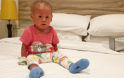 Hình ảnh mới nhất của bé Bích bị bỏ rơi, người đầy vẩy ngứa như da trăn sau đợt khám bệnh đầu tiên tại Singapore