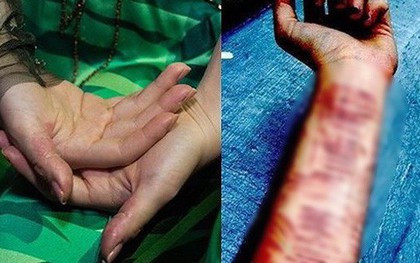 Ngoài tự bóc da tay, giới trẻ còn có nhiều cách tự ngược đãi bản thân kinh khủng hơn