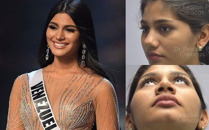 Được khen đẹp như Kim Kardashian, Á hậu Miss Universe 2018 bị khui lại ảnh quá khứ khác một trời một vực