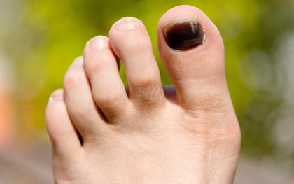 Móng chân tím đen là dấu hiệu cảnh báo sức khoẻ mà bạn không nên xem thường