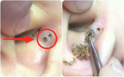 "Quái vật" mụn đầu đen mọc trong tai và hóa ra lý do lại là thói quen rất nhiều người mắc