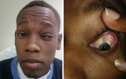 Chàng trai 25 tuổi bị mù một bên mắt vì đeo kính áp tròng giá rẻ