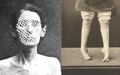 Những hình ảnh rùng rợn tại một trại thương điên thế kỷ 19 ở Pháp, nơi mà phần lớn bệnh nhân bị chữa trị... nhầm bệnh