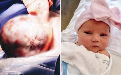 Những hình ảnh đáng yêu của bé gái chào đời với màng ối quanh đầu: 80,000 ca sinh mới có 1 trường hợp như vậy