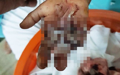 Long An: Bé trai 3 tuổi bị dây sên xe máy cuốn đứt lìa hai ngón tay