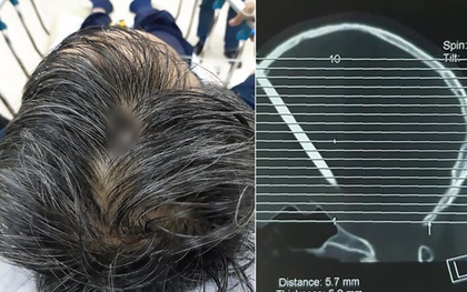 Báo Anh đưa tin bệnh nhân Việt không chịu đi khám dù đinh 8 cm xuyên vào đầu