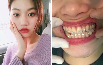 Cô gái hi sinh gắn đá nguyên hàm răng, dân mạng mỗi người vào nói một câu nghe chỉ thấy tiếc tiền