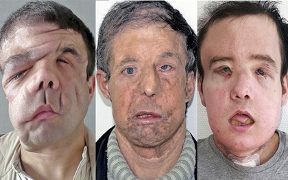Trải qua 2 cuộc phẫu thuật ghép mặt đầy đau đớn, đây là người đàn ông đầu tiên trên thế giới có 3 khuôn mặt