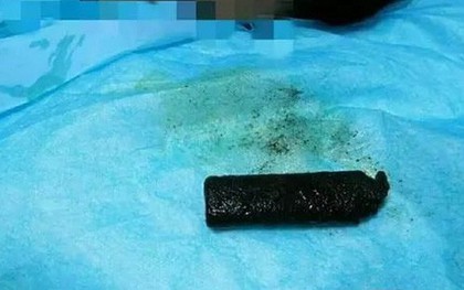Bác sĩ lấy ra chiếc bật lửa bệnh nhân đã nuốt 20 năm trước, kết quả sẽ khiến bạn thực sự rùng mình