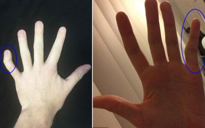 Đây là lí do của những ngón tay “cong gấp khúc” gây sốt cư dân mạng - liệu có “bẻ thẳng” được không?