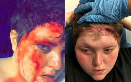 Phớt lờ cảnh báo, cô gái vẫn mang bộ tóc giả quá chật để rồi lãnh vết thương đầm đìa máu, dài tới 15cm trên mặt