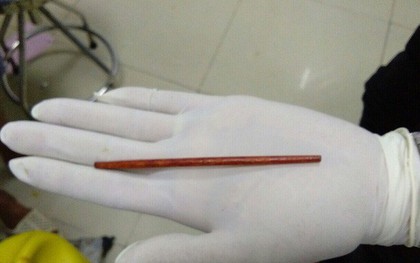 Say xỉn, người đàn ông ở Đồng Nai bị bạn nhậu ghim chiếc đũa 12 cm thẳng vào của quý