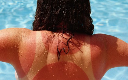 Nếu bạn bị cháy nắng, hãy thực hiện 6 điều này ngay lập tức để làm dịu da