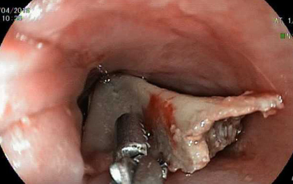 Vừa xem tivi vừa ăn đùi gà, bé gái 13 tuổi ở Bình Dương suýt chết vì nuốt xương