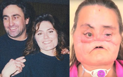 Gã chồng ghen tuông “san phẳng” khuôn mặt vợ bằng một phát súng oan nghiệt, 4 năm sau điều kỳ diệu đã xảy ra