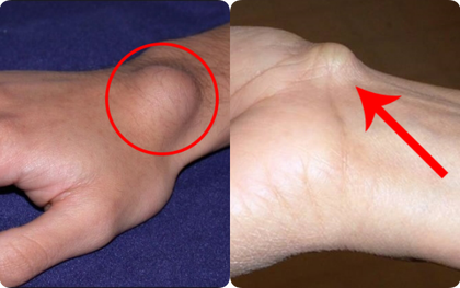 Xuất hiện cục u nổi bất thường ở cổ tay: Đừng bỏ qua vì đó có thể là dấu hiệu cảnh báo bệnh nguy hiểm