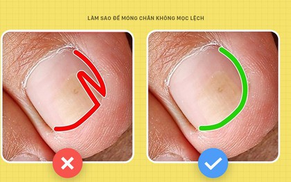 Móng chân mọc quặp đau phát khóc, mẹo nhỏ này sẽ giúp bạn thoát khỏi cơn đau