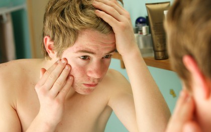 Những dấu hiệu cảnh báo stress đang tàn phá ngoại hình của bạn