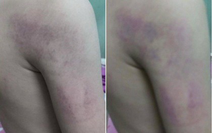 Hà Nội: Phụ huynh tố giáo viên chủ nhiệm đánh con trai lớp 1 bầm tím vì trình bày bài không trôi chảy