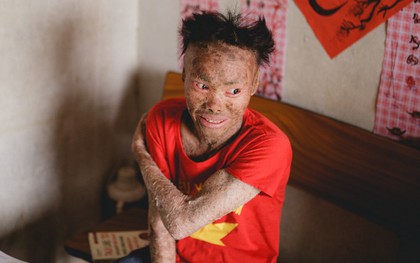 Chàng trai "người cá" lạc quan ở Hà Nội: Nhìn thấy bộ dạng của mình, nhiều người hỏi sao không chết đi, sống để làm gì?